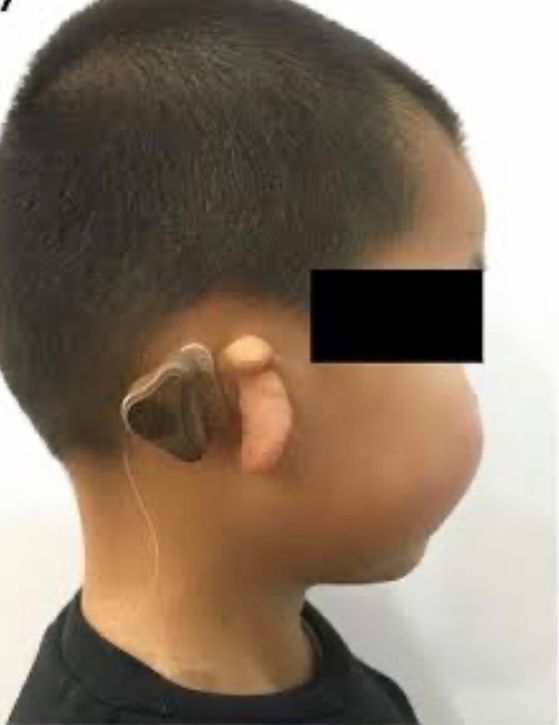 Equipo especializado para Tamiz Auditivo