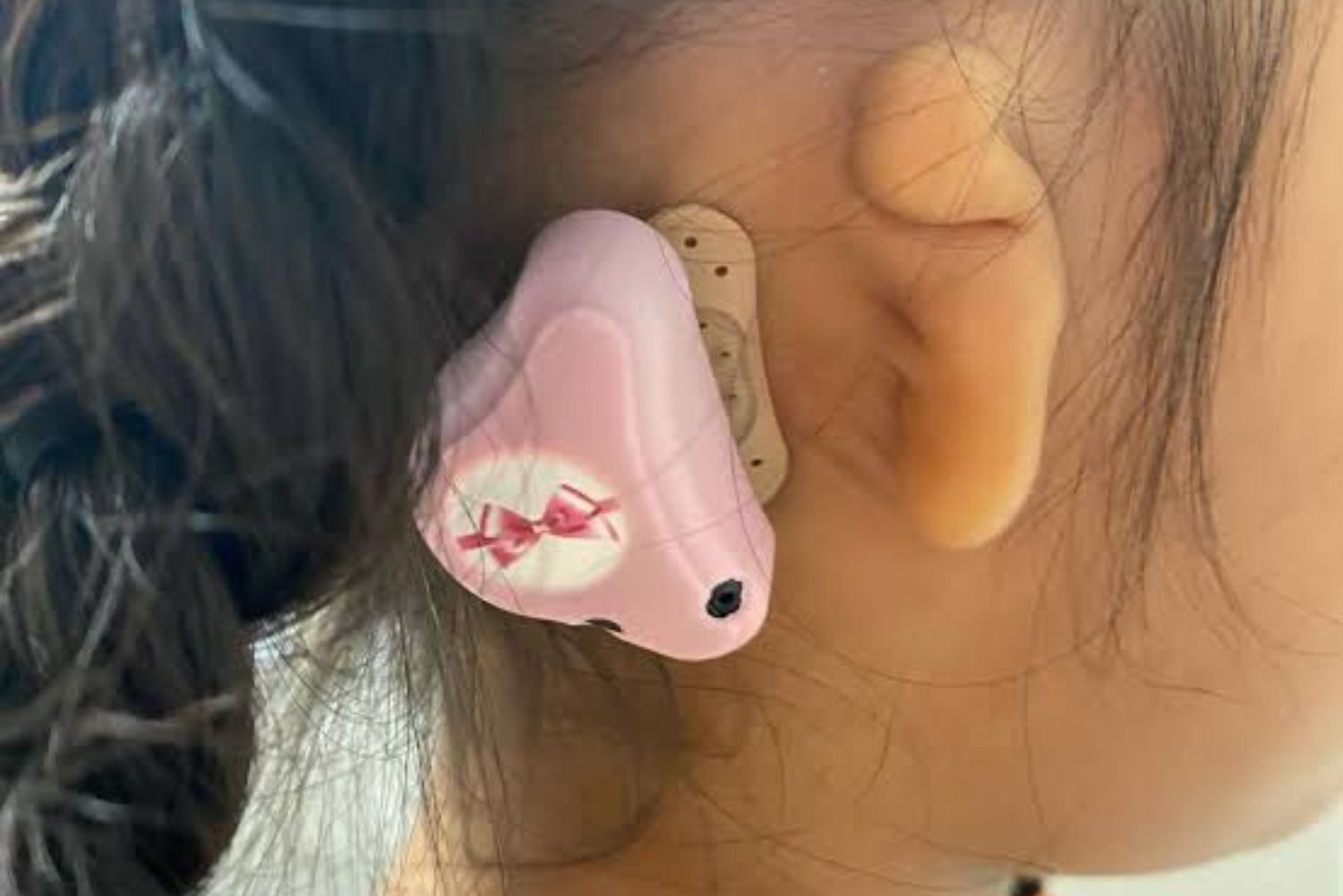 Soluciones Audiológicas para Microtia